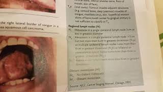 Squamous cell carcinoma of oral cavity [upl. by Kama]