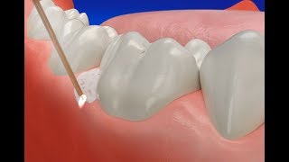 How Gum Disease Treatment Laser works [upl. by Adam]