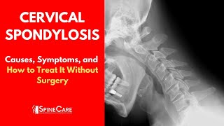 Cervical Spondylosis Causes Symptoms and Treatment [upl. by Alyhs143]