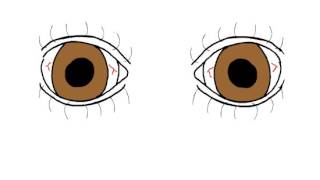 Myasthenia Gravis  Before and After Tensilon [upl. by Galen258]