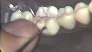 Class I Buccal Pit Cohesive Gold Foil [upl. by Colson]