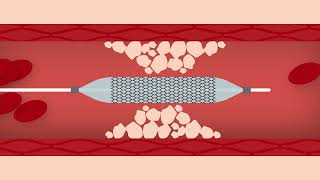 Heart Stent Procedure [upl. by Kyre]