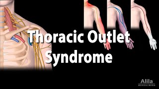 Thoracic Outlet Syndrome TOS Animation [upl. by Ahsennod844]