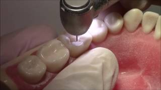 Tutorial on Class I Cavity Preparation Amalgam Restoration  DENTALKART [upl. by Aserret]