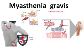 Myasthenia gravis  causes symptoms treatment pathology [upl. by Azil990]